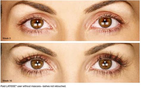 The most frequently reported adverse reactions following injection of BOTOX ® Cosmetic for glabellar lines were eyelid ptosis (3%), facial pain (1%), facial paresis (1%), and muscular weakness (1%). The most frequently reported adverse reaction following injection of BOTOX ® Cosmetic for lateral canthal lines was eyelid edema (1%).
